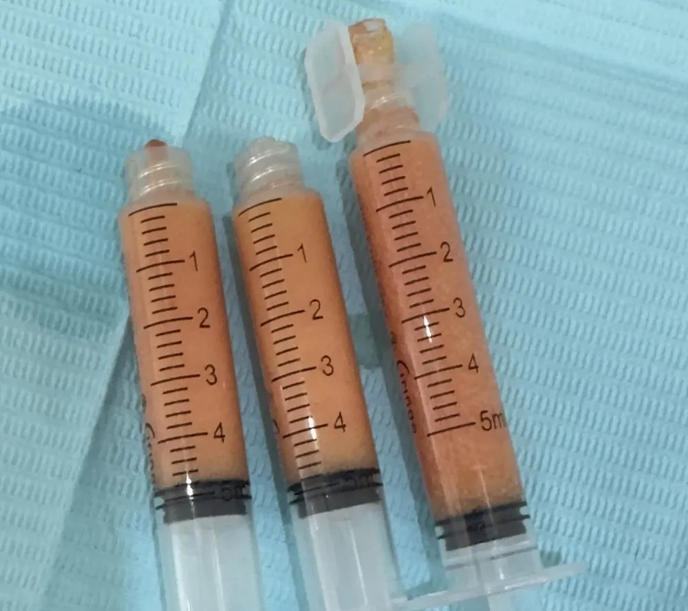 Three 5ml syringes filled with EZ Gel plasma bio-filler, ready for treatment