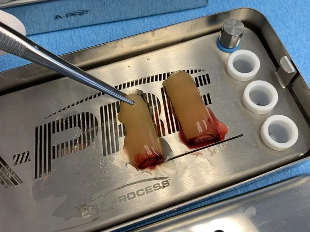 Two PRF clots resting on a steel PRF tray beside tweezers, ready for use as a membrane or matrix