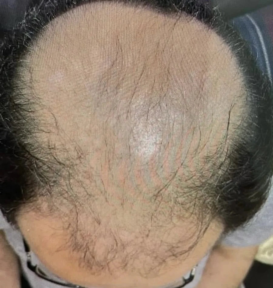 Top view of a scalp with hair thinning across the crown