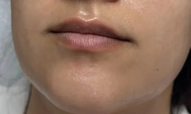 Close-up of the lips and chin showing natural, untreated lips