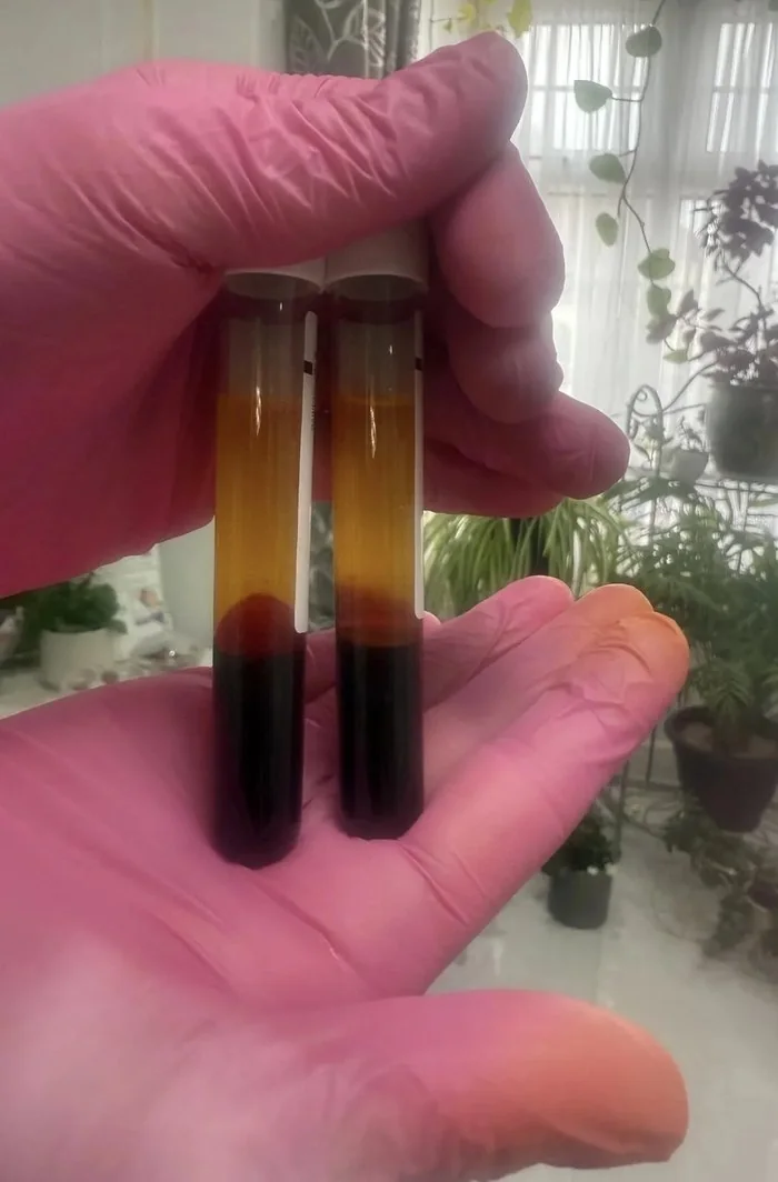 Two tubes of blood after centrifugation, held in gloved hands, with the golden plasma layer above the red cells
