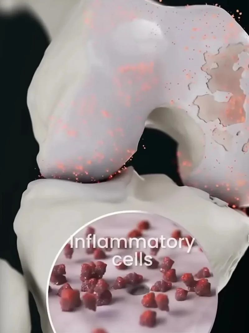 3D illustration of a knee joint with worn cartilage and a magnified view of inflammatory cells