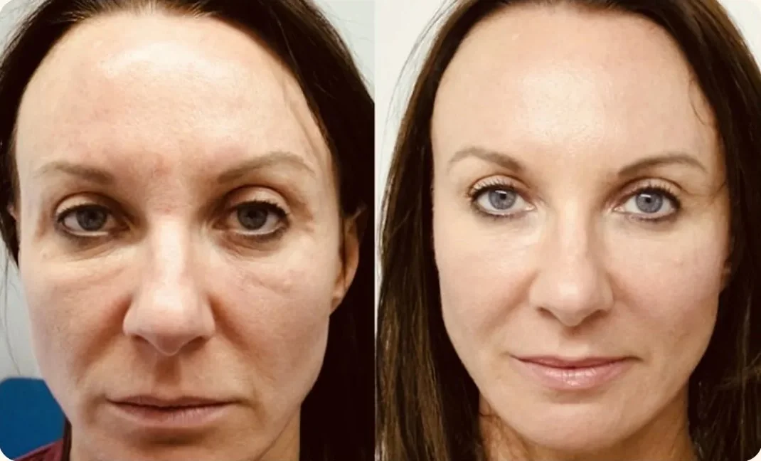 Side-by-side front-facing photographs of a face, before and after treatment