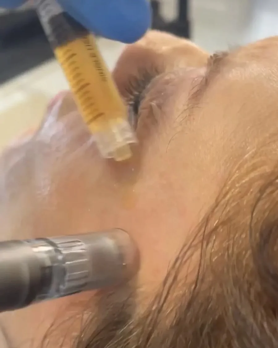 Gloved clinician using a microneedling pen on the temple while golden plasma from a syringe is applied to the skin