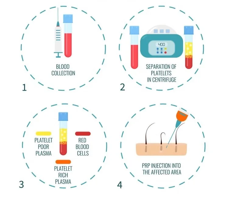 PRP process in four steps: 1 blood collection, 2 separation of platelets in a centrifuge, 3 the blood separates into platelet-poor plasma, platelet-rich plasma and red blood cells, 4 PRP injection into the affected area