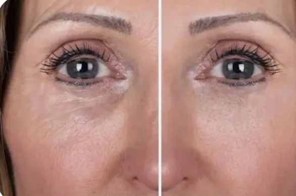 Side-by-side before and after comparison of the under-eye area